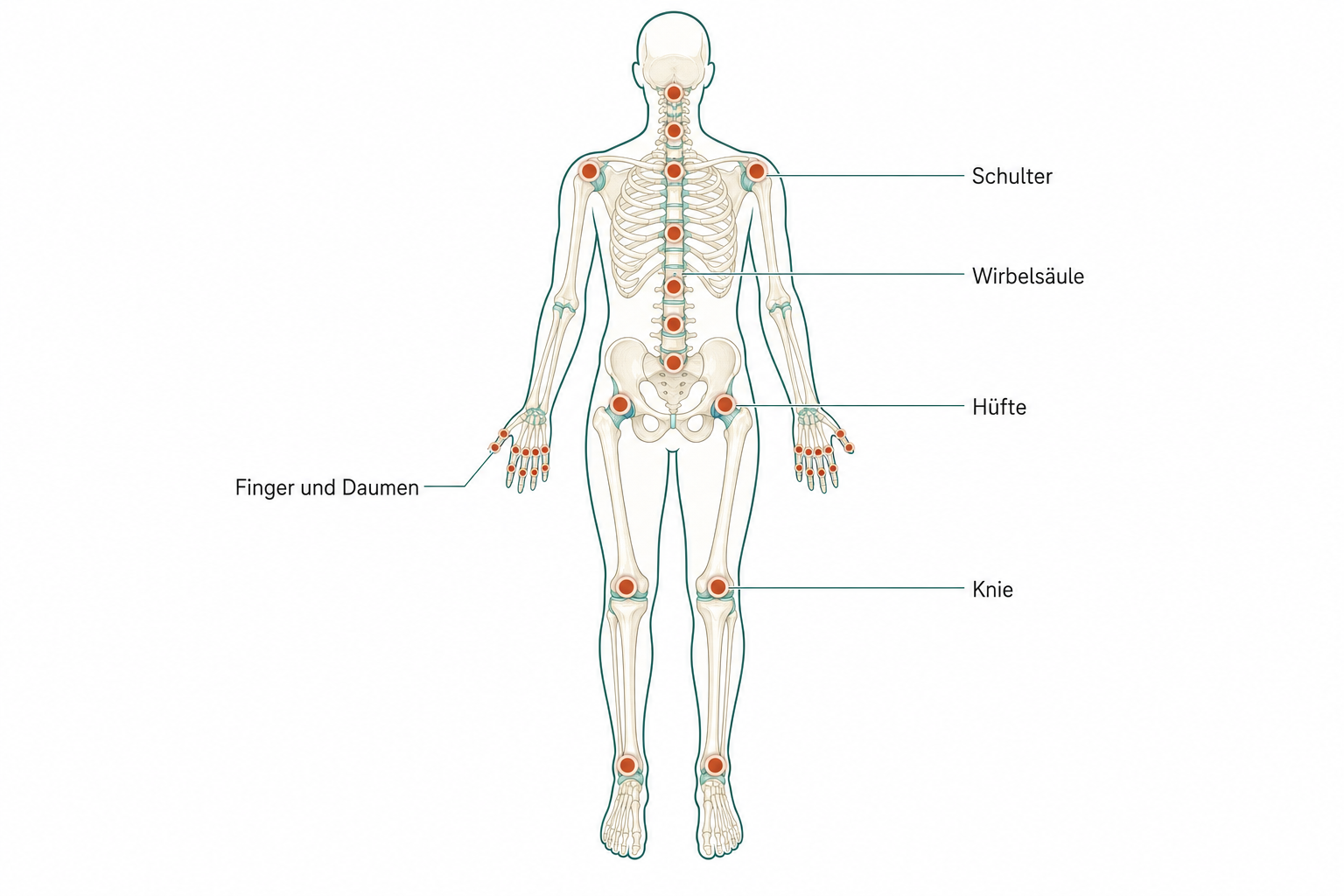 Frontaler Körperumriss mit terrakottafarbenen Hotspots an Knie, Hüfte, Wirbelsäule, Fingern und Daumen, Schulter und Sprunggelenken.