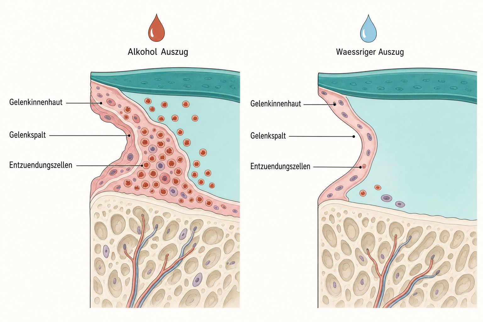 Vergleichender Gewebeschnitt des Gelenkspalts: links unter Alkohol-Auszug der Teufelskralle ausgeprägte Entzündung und Schwellung, rechts unter wässrigem Auszug weniger Entzündungszellen und geringere Schwellung.