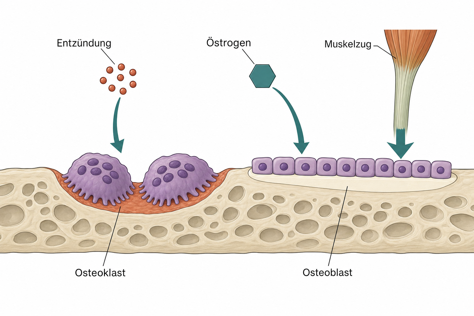 Schema eines Knochenbälkchens im Umbau: links mehrkernige Osteoklasten, die eine terrakottafarbene Bucht in den Knochen fressen, rechts kleine Osteoblasten, die neue Knochenschicht anlegen, darüber drei Einflusspfeile für Östrogen, Entzündung und Muskelzug
