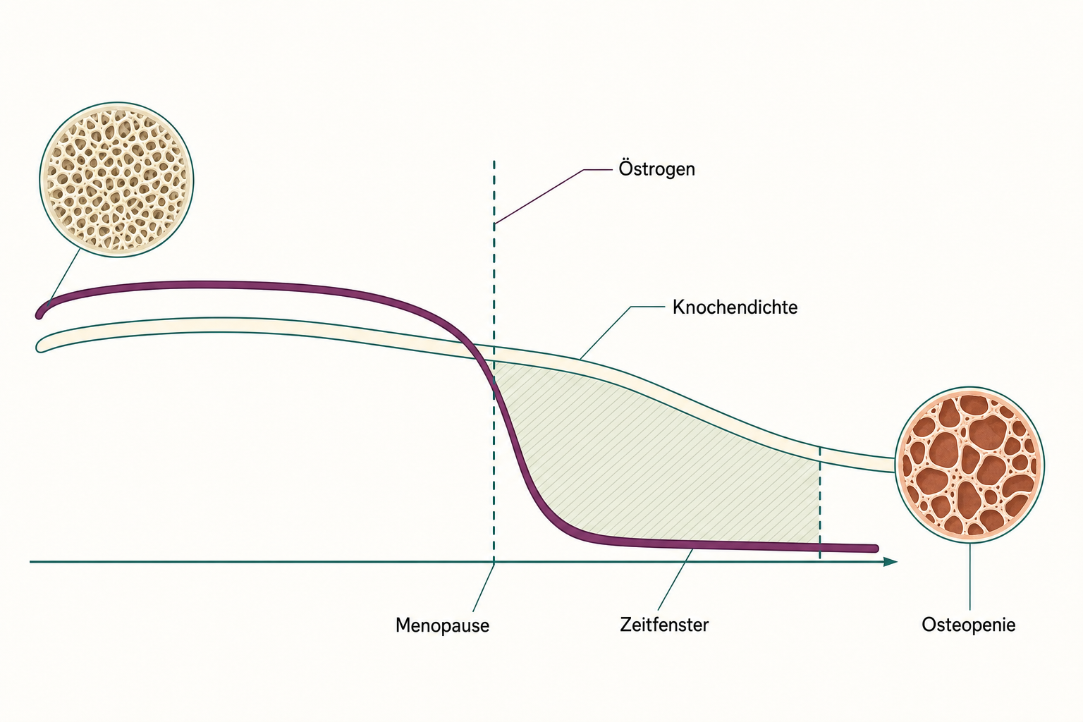 Zeitachsen-Schema mit fallender Östrogenkurve und zeitversetzt sinkender Knochendichte, die Menopause als gestrichelte Linie, danach ein schraffiertes Zeitfenster, rechts ein Wirbelkörperausschnitt mit ausgedünnten Knochenbälkchen