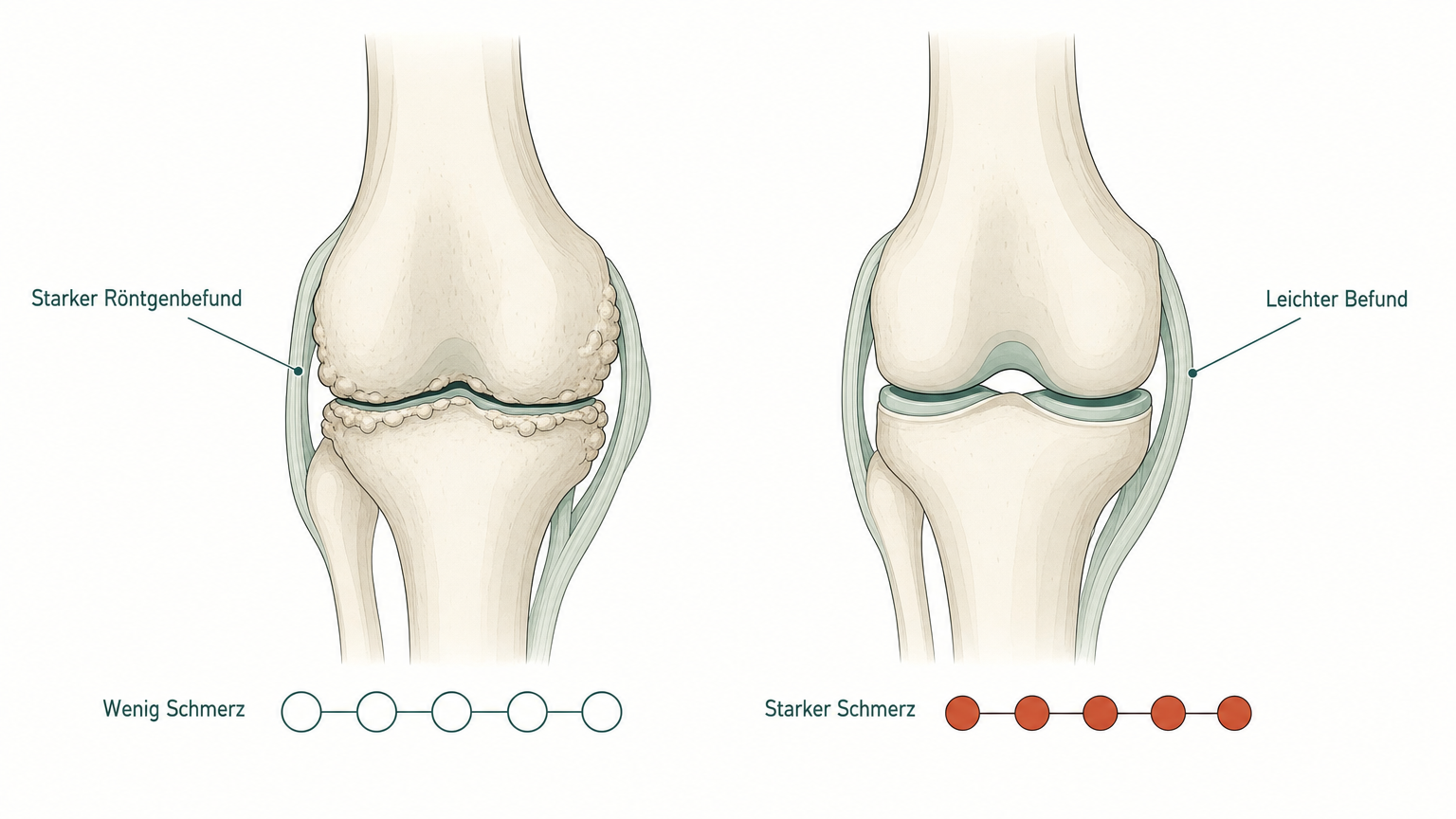 Schematischer Vergleich zweier Knie: starker Röntgenbefund mit wenig Schmerz gegenüber leichtem Befund mit starkem Schmerz